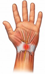 syndrom karpálního tunelu, endoskopická operace, karpály