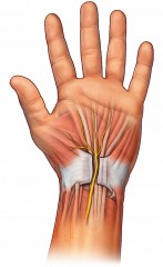 syndrom karpálního tunelu, endoskopická operace, karpály